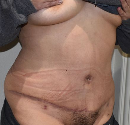 Tummy Tuck (Abdominoplasty): Case 273 - After
