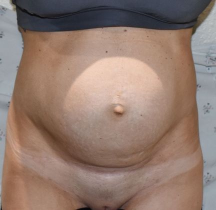 Tummy Tuck (Abdominoplasty): Case 274 - Before
