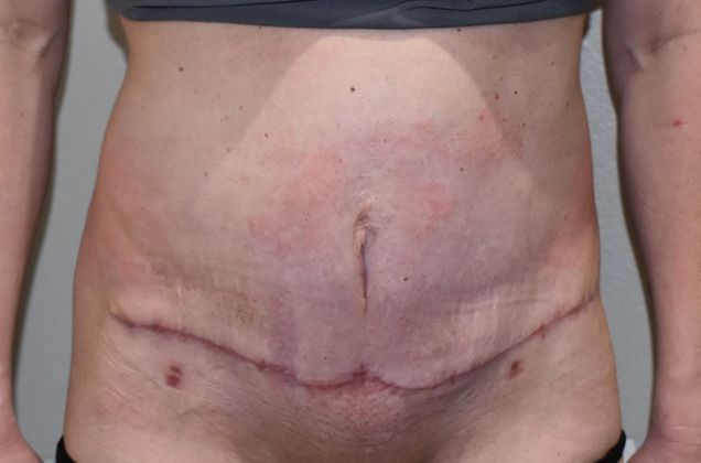 Tummy Tuck (Abdominoplasty): Case 274 - After