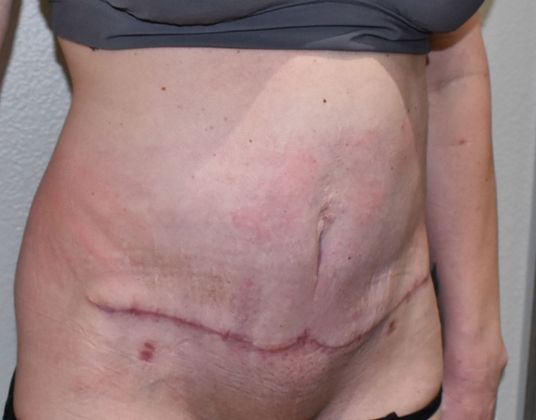 Tummy Tuck (Abdominoplasty): Case 274 - After