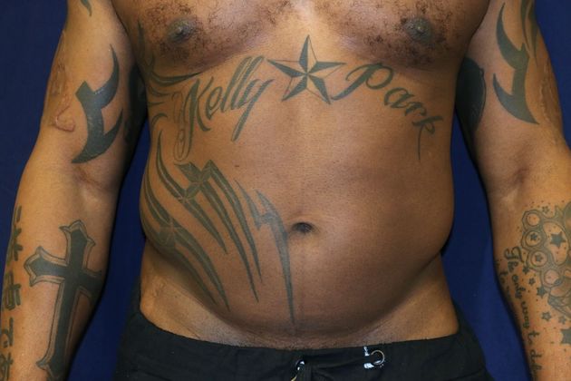 Abdominal Etching : Case 1 - Before Lipo and Abdominal Etching