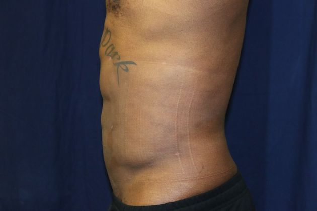 Abdominal Etching : Case 1 - After Lipo and Etching