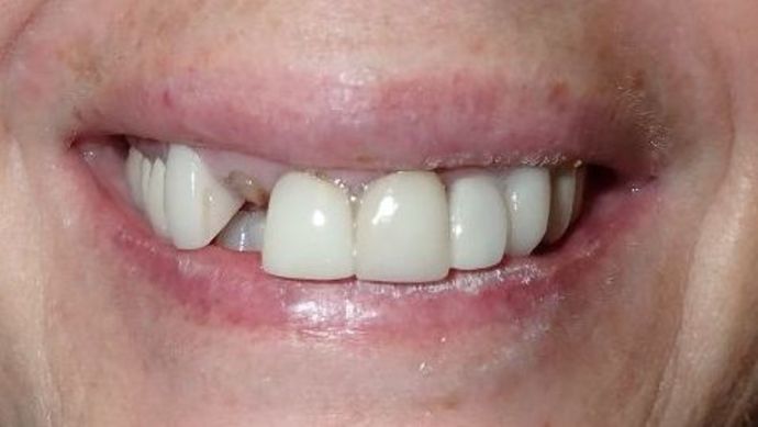 Porcelain Veneers: Case 5 - Before