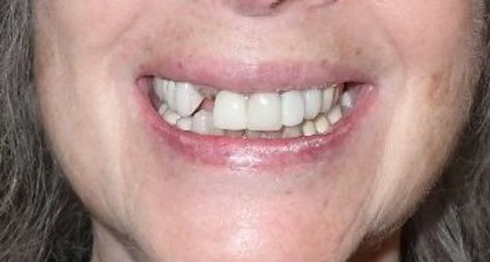 Porcelain Veneers: Case 5 - Before