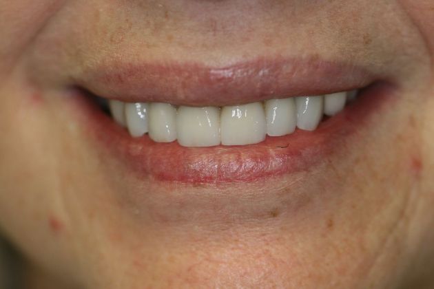 Porcelain Veneers: Case 5 - After