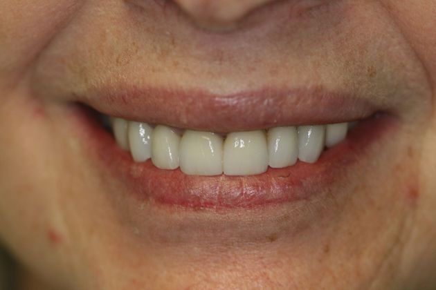 Porcelain Veneers: Case 5 - After