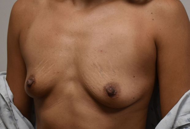 Breast Augmentation: Case 627 - Before
