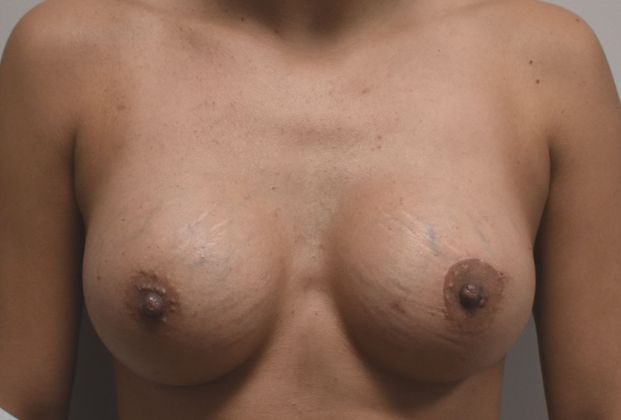 Breast Augmentation Case 627 - After
