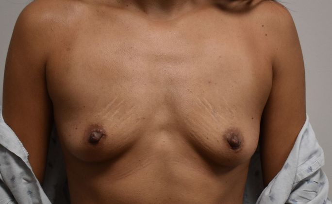 Breast Augmentation Case 627 - Before