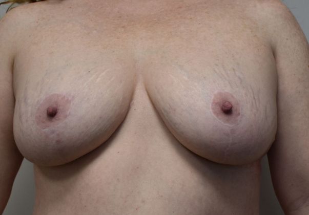 Breast Augmentation w/ Lift Case 352 - After