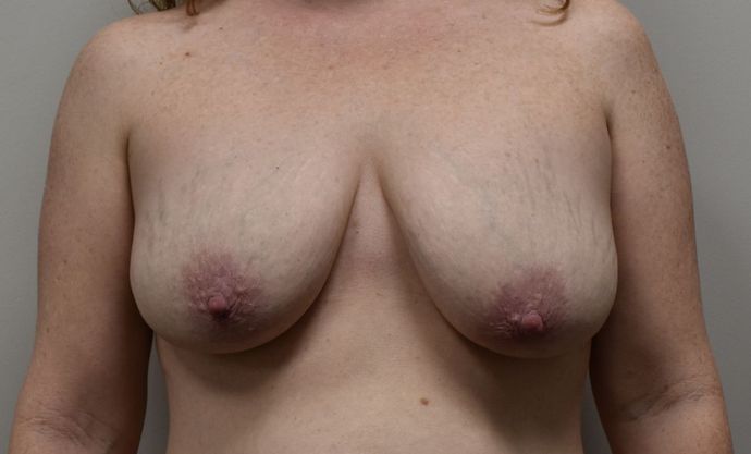 Breast Augmentation w/ Lift Case 352 - Before