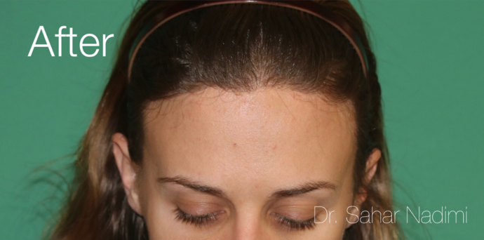 Hairline Lowering Surgery: Case 15 - After