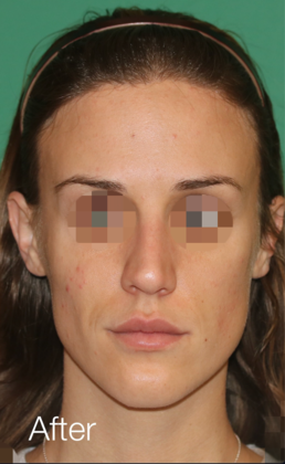 Hairline Lowering Surgery: Case 15 - After