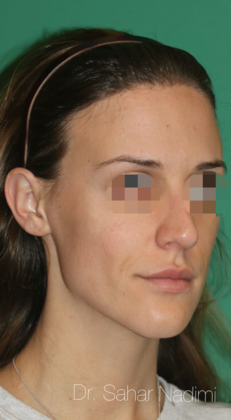 Hairline Lowering Surgery: Case 15 - After