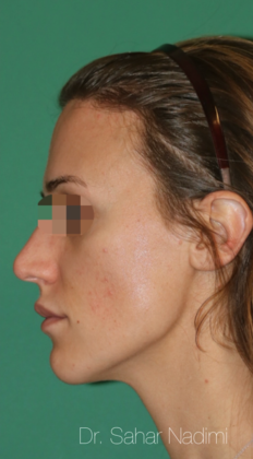 Hairline Lowering Surgery: Case 15 - After