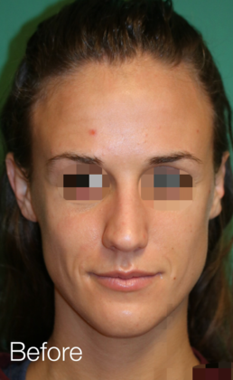 Hairline Lowering Surgery: Case 15 - Before