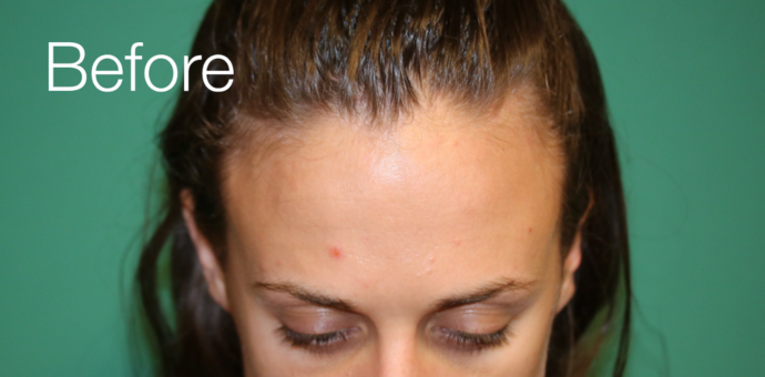 Hairline Lowering Surgery: Case 15 - Before