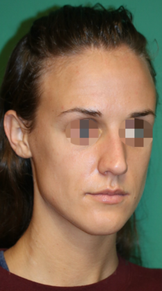 Hairline Lowering Surgery: Case 15 - Before