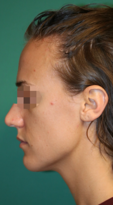 Hairline Lowering Surgery: Case 15 - Before