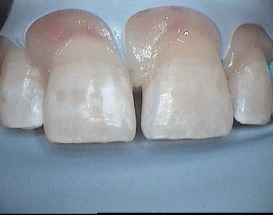 Dental Bonding - Teeth Bonding  Dental Bonding to Whiten & Close Split Between Front Teeth - Before