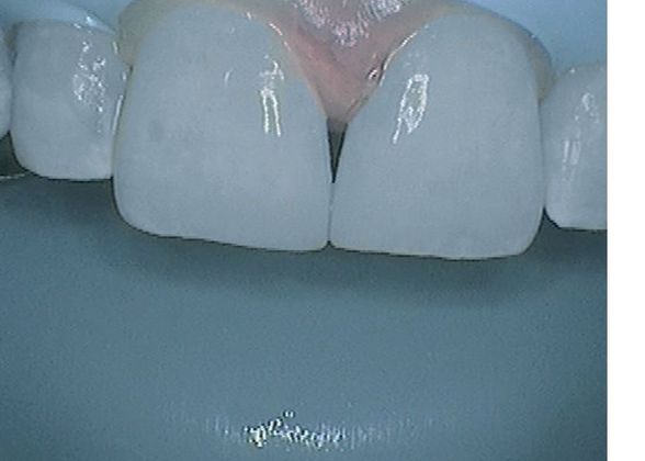 Dental Bonding - Teeth Bonding  Dental Bonding to Whiten & Close Split Between Front Teeth - After