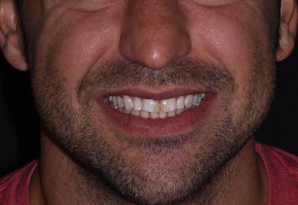 Cosmetic Dentistry Case 8: Veneer- Hollywood Makeover - Before