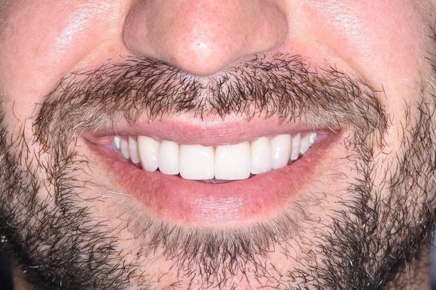 Cosmetic Dentistry Case 8: Veneer- Hollywood Makeover - After