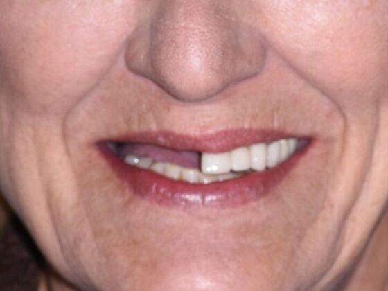 All on 4 (Full Arch Implant Cases) Case 4: 8 implant upper bridges, Lower All on 4) - Before