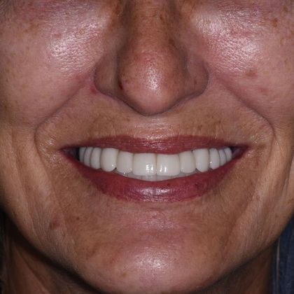 All on 4 (Full Arch Implant Cases) Case 4: 8 implant upper bridges, Lower All on 4) - After