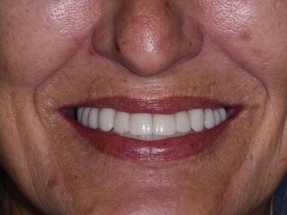 All on 4 (Full Arch Implant Cases) Case 4: 8 implant upper bridges, Lower All on 4) - After