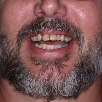 All on 4 (Full Arch Implant Cases) Case 5: Upper and Lower All on 4 - Before