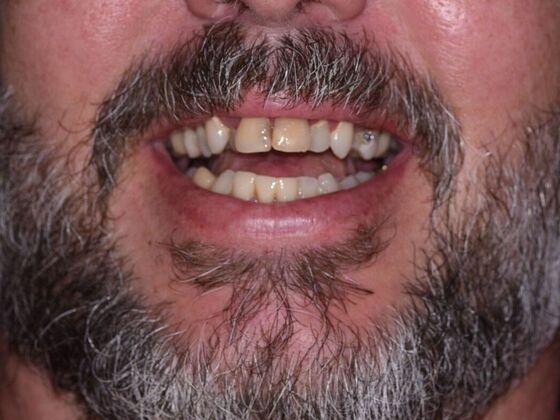 All on 4 (Full Arch Implant Cases) Case 5: Upper and Lower All on 4 - Before