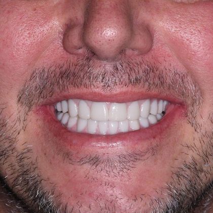 All on 4 (Full Arch Implant Cases) Case 5: Upper and Lower All on 4 - After