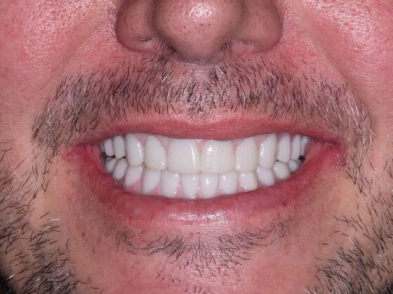 All on 4 (Full Arch Implant Cases) Case 5: Upper and Lower All on 4 - After