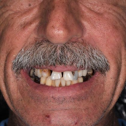 All on 4 (Full Arch Implant Cases) Case 6: All on 4 (upper and lower arches) - Before