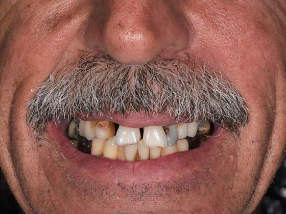 All on 4 (Full Arch Implant Cases) Case 6: All on 4 (upper and lower arches) - Before