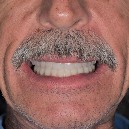 All on 4 (Full Arch Implant Cases) Case 6: All on 4 (upper and lower arches) - After