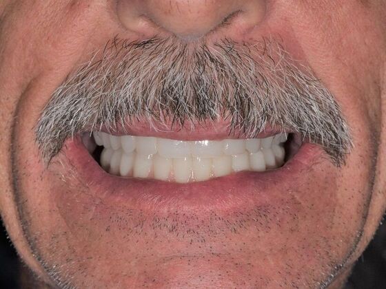 All on 4 (Full Arch Implant Cases) Case 6: All on 4 (upper and lower arches) - After