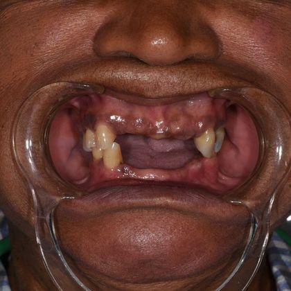 All on 4 (Full Arch Implant Cases) Case 7: Upper and Lower All on 4  - Before