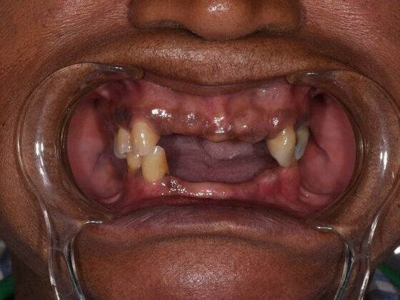 All on 4 (Full Arch Implant Cases) Case 7: Upper and Lower All on 4  - Before