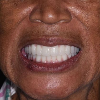 All on 4 (Full Arch Implant Cases) Case 7: Upper and Lower All on 4  - After