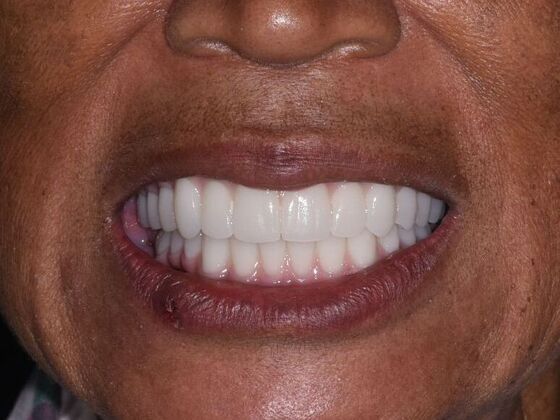 All on 4 (Full Arch Implant Cases) Case 7: Upper and Lower All on 4  - After