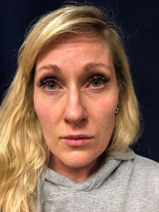 Cosmetic Injectables & Fillers*: Case 25 Cheek & Undereye Filler - Before