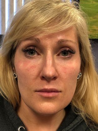 Cosmetic Injectables & Fillers*: Case 25 Cheek & Undereye Filler - After