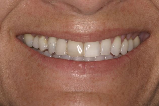 Porcelain Crowns: Case 1 - Before