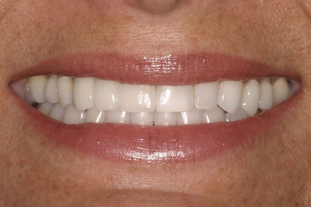 Porcelain Crowns: Case 1 - After