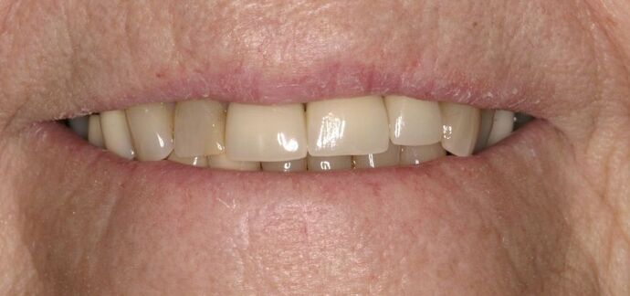 Porcelain Crowns: Case 4 - Before