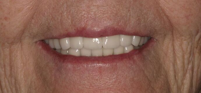 Porcelain Crowns: Case 4 - After