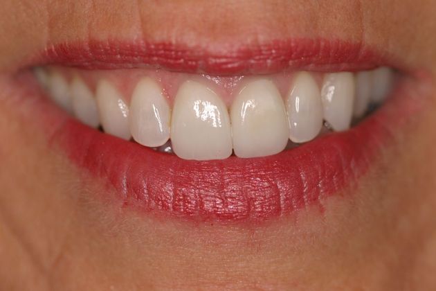 Porcelain Crowns Case 5 - After