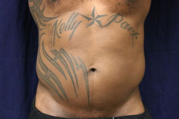 Liposuction & Safe Lipo Case 44 - Before